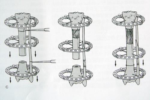 骨搬移手术原理图图片