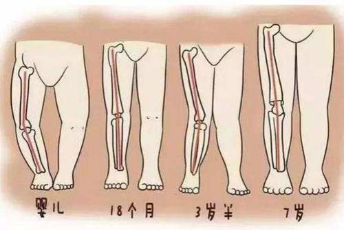 相碰时两膝也能靠拢为正常,如果两膝相碰而两内踝不能靠拢为膝外翻