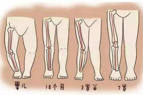 宝宝膝盖内翻图片图片
